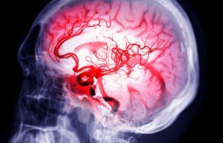 Une représentation médicale du cerveau humain sur fond noir, illustrant l'inflammation et la dilatation du réseau vasculaire crânien.