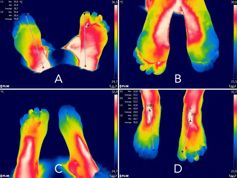 Une image thermique révélant un torse humain rougeoyant de chaleur, contrastant violemment avec des extrémités (mains et pieds) bleuies par le froid.