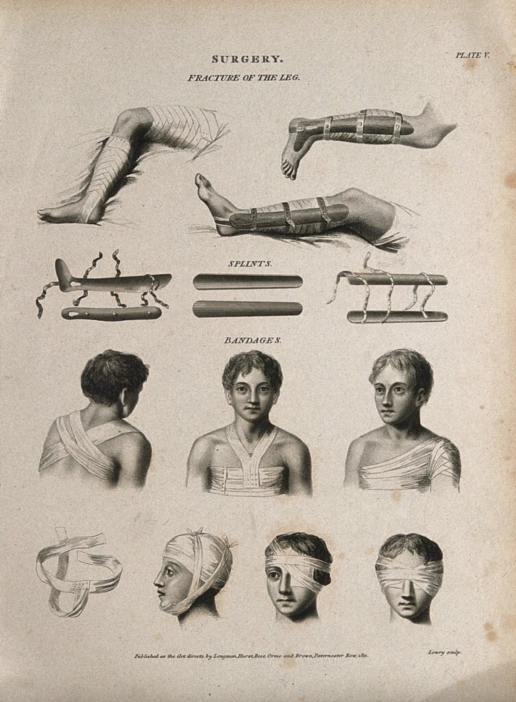 Schéma historique illustrant l'immobilisation d'une jambe par attelle